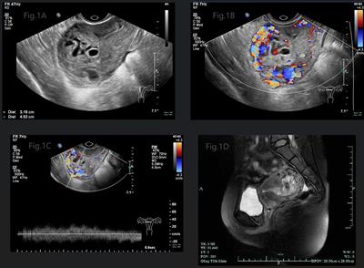 Rapid progression from complete molar pregnancy to post-molar gestational trophoblastic neoplasia: a rare case report and literature review